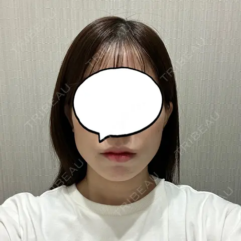 糸リフト / 脂肪吸引（顔） / 脂肪吸引（二の腕） / 脂肪吸引（肩） / ボトックス（エラ・小顔） / ボトックス（肩） ヴェルトラクリニック 大阪院 AFTER