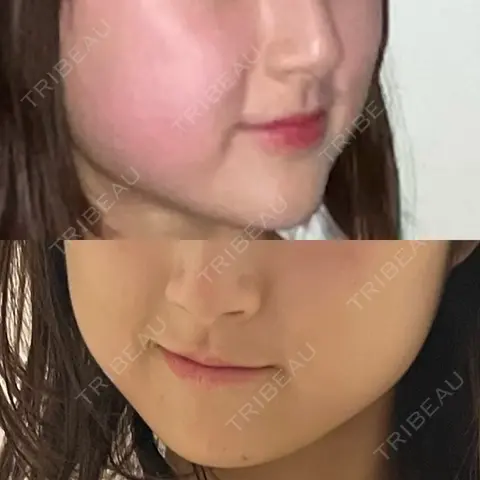 RF（高周波）たるみ治療 BISIN GINZA CLINIC AFTER