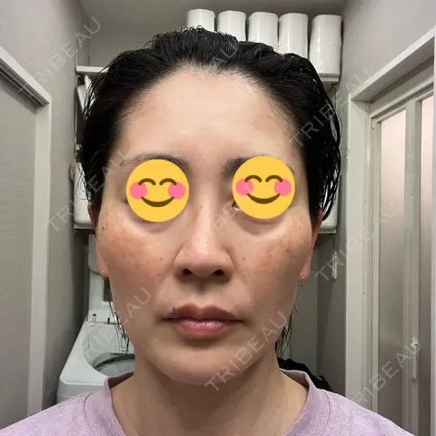 美容点滴・美容注射（美肌） / 白玉点滴・注射 / 美肌レーザー / シミ取りレーザー / 美白レーザー / ピコレーザートーニング（美白・肝斑） / レーザートーニング（美白・肝斑） / レーザーフェイシャル LE CLINIC AFTER