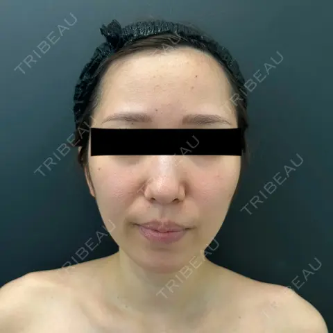 糸リフト / バッカルファット除去 / 脂肪吸引（顔） BLINC CLINIC （ブリンク クリニック） AFTER