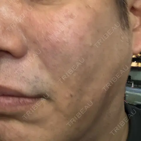 RF（高周波）たるみ治療 BISIN GINZA CLINIC AFTER