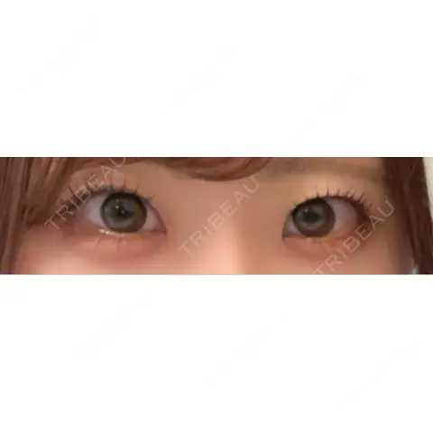 二重埋没 THE FIRST CLINIC 多摩センター院 AFTER