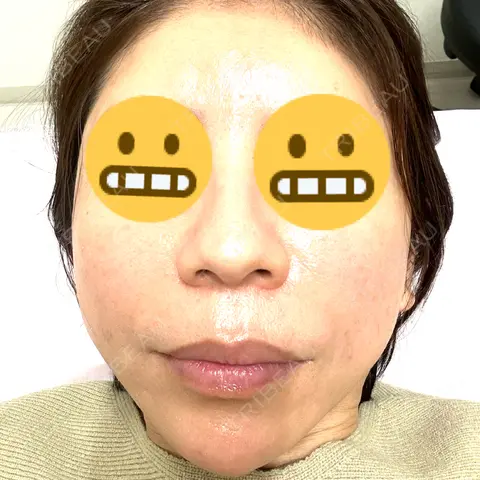 マイクロボトックス ルラ美容クリニック 千葉院 AFTER
