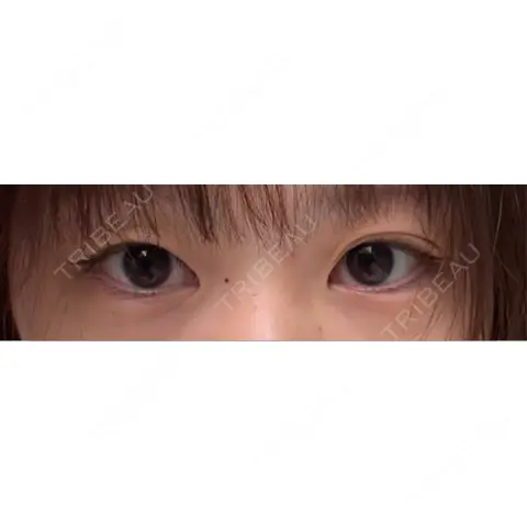 二重埋没 9BeautyClinic AFTER