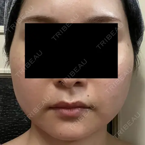 脂肪吸引（顔） / 脂肪吸引（脚） / 脂肪注入（目の下） / ボトックス（エラ・小顔） Mods Clinic（モッズクリニック） 東京院 AFTER
