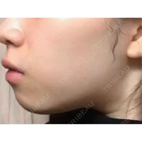 脂肪吸引（顔） / 脂肪吸引注射（顔） ziz CLINIC AFTER