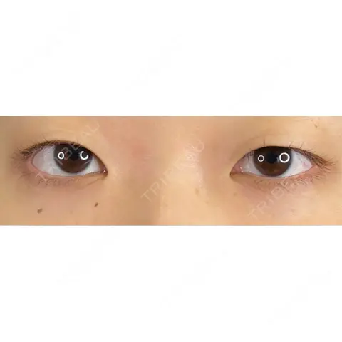 二重埋没 / クマ治療 / 脂肪注入（目の下） 藤・ナチュレ美容クリニック 銀座院 AFTER