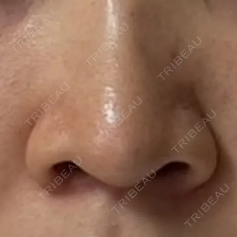 鼻尖形成（切開） / 鼻中隔延長（切開） / 小鼻縮小（切開） / 骨切幅寄せ / ワシ鼻修正・ハンプ切除 セギム美容整形外科 AFTER