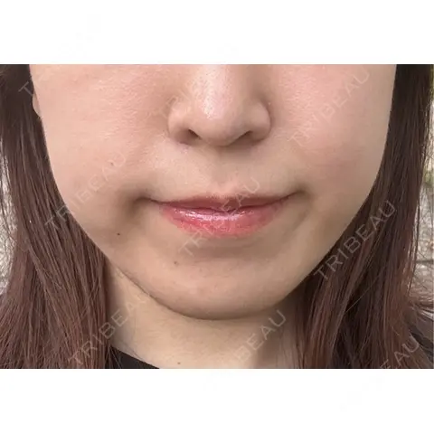 脂肪吸引注射（顔） 東京シンデレラ美容外科 池袋院 AFTER
