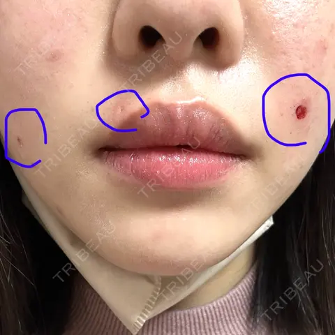 ほくろ・いぼ除去レーザー（肌） Mavie Beauty Clinic （マヴィービューティークリニック） AFTER