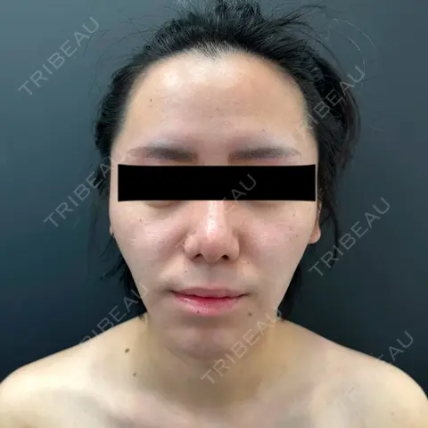 メーラーファット除去 BLINC CLINIC （ブリンク クリニック） AFTER