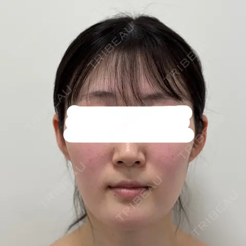 糸リフト / 脂肪吸引（顔） / 脂肪注入（額） / ジョールファット除去 / 脂肪吸引注射（顔） SEA CLINIC（シークリニック） AFTER