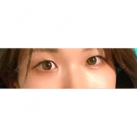 二重埋没 / 自然癒着法 Brandnew Beauty Clinic AFTER