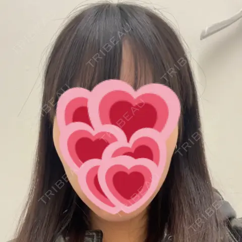 ボトックス（エラ・小顔） TCB東京中央美容外科 札幌駅前院 AFTER