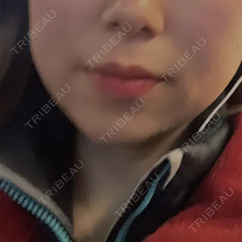 RF（高周波）たるみ治療 BISIN GINZA CLINIC AFTER