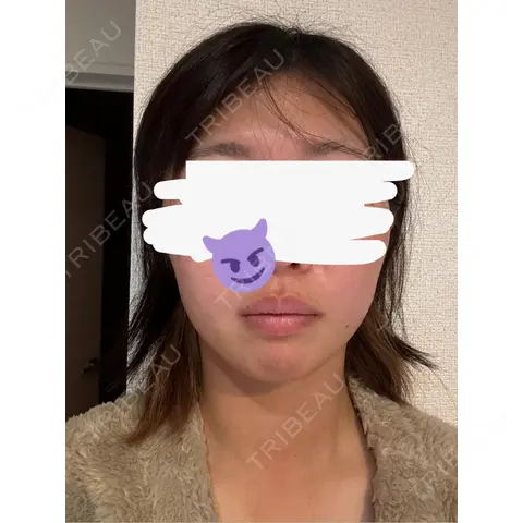 RF（高周波）たるみ治療 / その他（鼻） ルラ美容クリニック 千葉院 AFTER