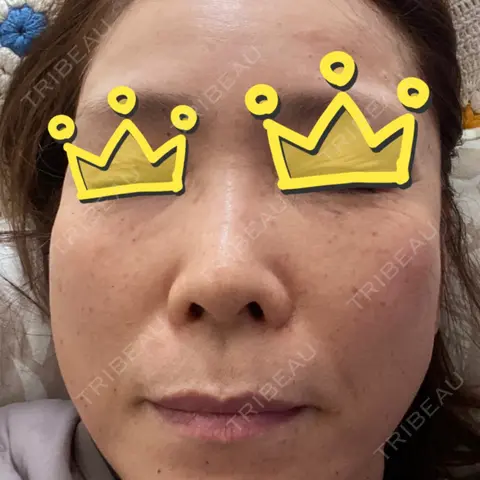 水光注射（ハリ・美肌） / その他（輪郭） ARTE SKIN CLINIC 【アルテスキンクリニック】 AFTER