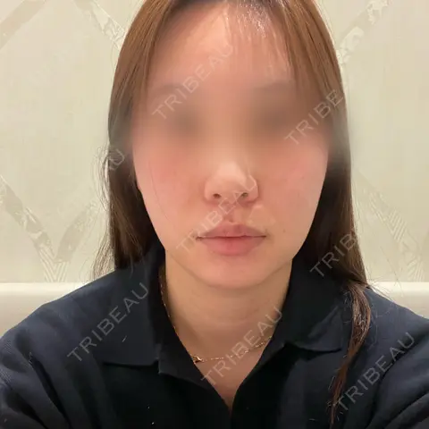 糸リフト / ヒアルロン酸注入（鼻） / ヒアルロン酸注入（あご） 銀座みゆき通り美容外科 大阪梅田院 AFTER