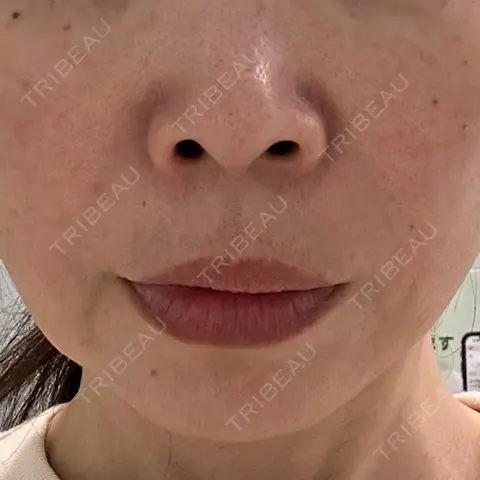 糸リフト ルラ美容クリニック 仙台院 AFTER