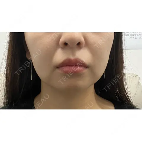 RF（高周波）たるみ治療 BISIN GINZA CLINIC AFTER