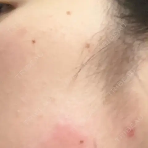 ほくろ・いぼ切除（肌） ルラ美容クリニック 新宿院 AFTER