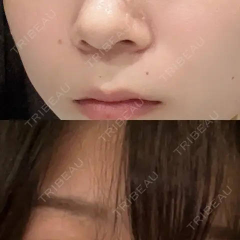 ほくろ・いぼ除去レーザー（肌） Mavie Beauty Clinic （マヴィービューティークリニック） AFTER