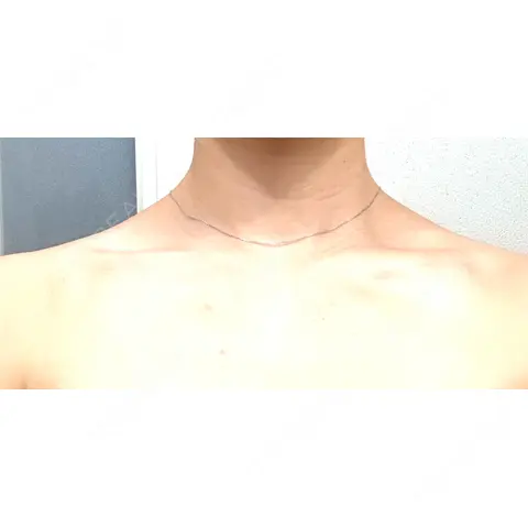 ボトックス（エラ・小顔） / ボトックス（肩） / ワキ汗治療（ボトックス） おおたかの森ビューティークリニック AFTER