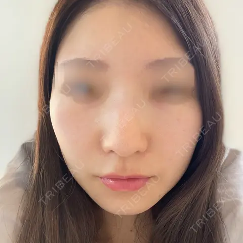 レーザートーニング（美白・肝斑） 銀座TSUBAKIクリニック AFTER