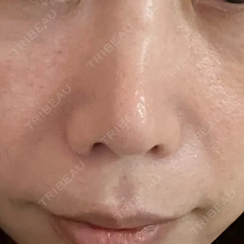 肌育注射（ジュベルックなど） DMTC美容皮膚科 渋谷院 AFTER