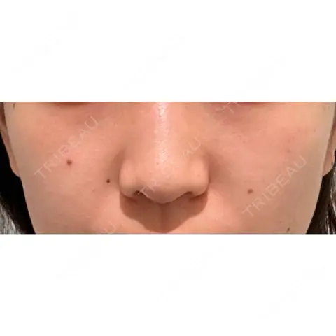 ほくろ・いぼ除去レーザー（肌） Fellez Clinic【フェルズクリニック】 AFTER