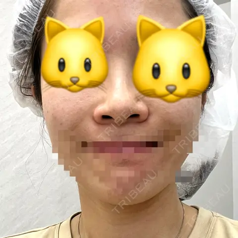 隆鼻術 / 鼻尖形成（切開） / 小鼻縮小（切開） / 軟骨移植 CLINIC W AFTER