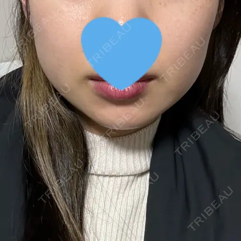 RF（高周波）たるみ治療 LUNA BEAUTY CLINIC 池袋駅前院 AFTER