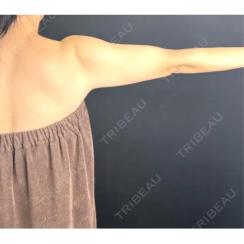 脂肪吸引（二の腕） 藤・ナチュレ美容クリニック 銀座院 AFTER