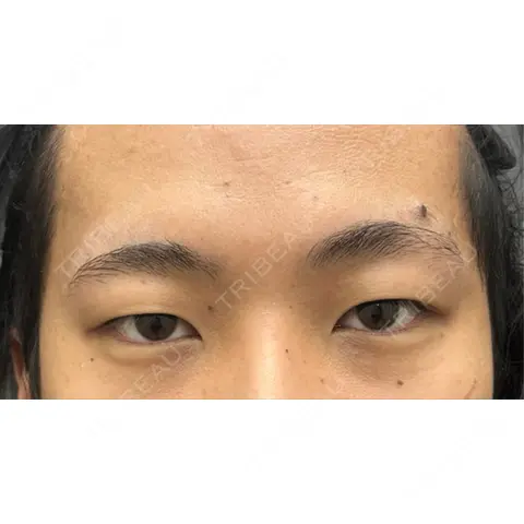 二重埋没 渋谷の森クリニック AFTER