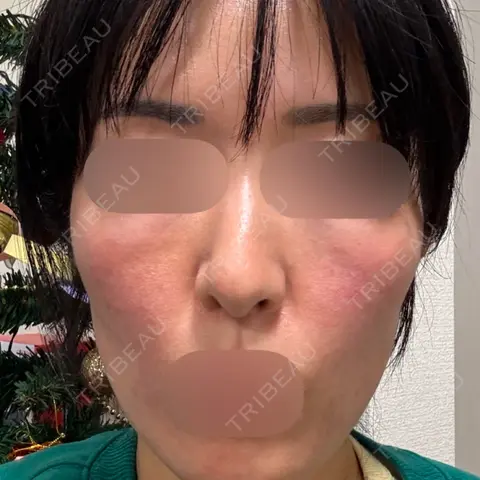 水光注射（ハリ・美肌） / リジュラン DAILY SKIN CLINIC 新宿院 AFTER