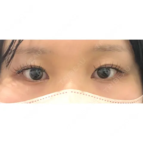 二重埋没 / 自然癒着法 Brandnew Beauty Clinic AFTER
