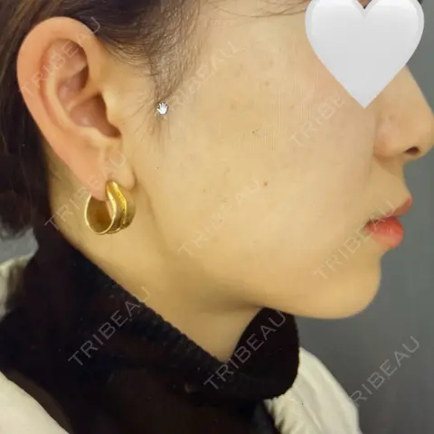 脂肪吸引（顔） / 脂肪吸引注射（顔） ziz CLINIC AFTER