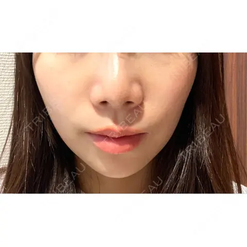 ヒアルロン酸注入（唇） / ヒアルロン酸注入（鼻翼基部） DMTC美容皮膚科 日本橋院 AFTER