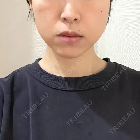 糸リフト / バッカルファット除去 / 脂肪吸引注射（顔） / ボトックス（あご） 湘南美容クリニック Regno 銀座院 AFTER