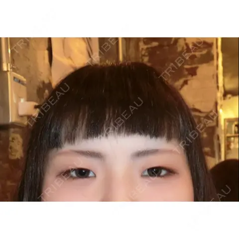 二重埋没 / 目頭切開 湘南メディカル記念病院（両国） AFTER