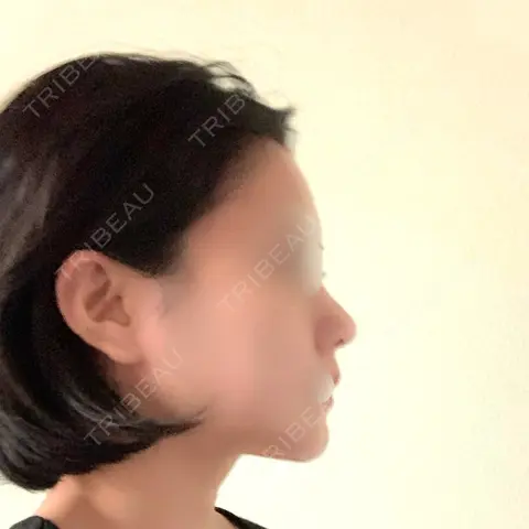 小鼻縮小（切開） / 骨切り（あご） / 骨削り（エラ） / 骨削り（頬） / 骨切幅寄せ / その他（鼻） セギム美容整形外科 AFTER