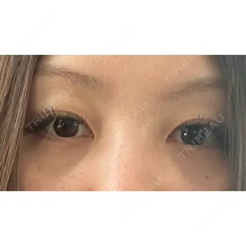 クマ治療 / 脂肪注入（目の下） ルラ美容クリニック 札幌院 AFTER