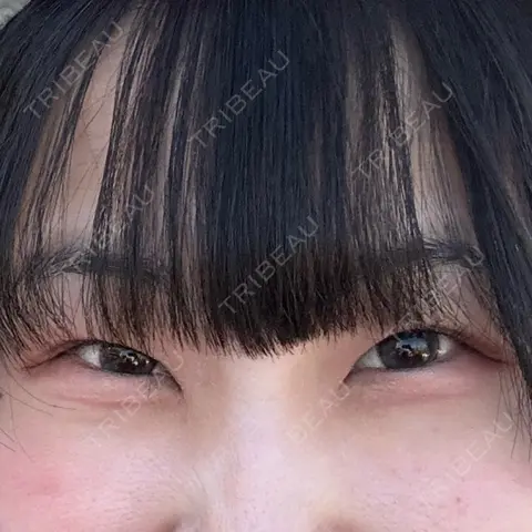二重埋没 / 目頭切開 / 上まぶたの脂肪取り HAAB×DREAM BEAUTY CLINIC 東京本院 AFTER