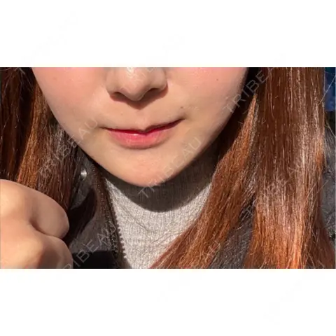口角挙上 / ヒアルロン酸注入（唇） R Beauty CLINIC 銀座院 AFTER