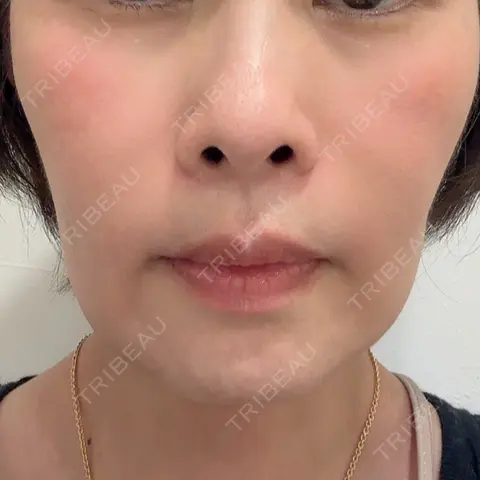 糸リフト Brandnew Beauty Clinic AFTER