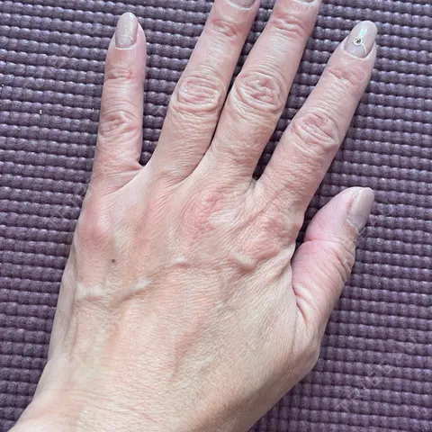 白玉点滴・注射 新宿美容内科医療クリニック AFTER