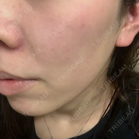 水光注射（ハリ・美肌） Fellez Clinic【フェルズクリニック】 AFTER