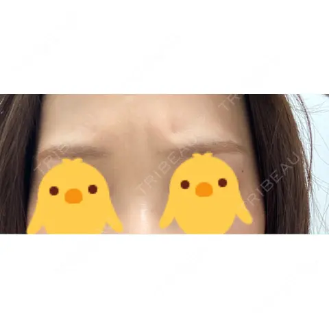 シワ取りボトックス / ボトックス（眉間） TCB東京中央美容外科 渋谷西口院 AFTER