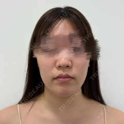 糸リフト / 脂肪吸引（顔） SEA CLINIC（シークリニック） AFTER
