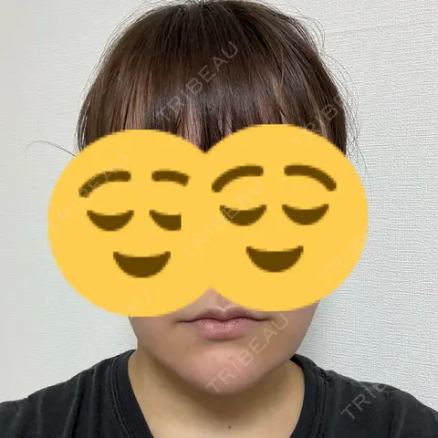 糸リフト / 脂肪吸引（顔） / 脂肪注入（輪郭） 東京ココセランクリニック AFTER